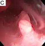 Bleeding and endometrial polyp