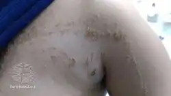 Epidermal nevus syndrome