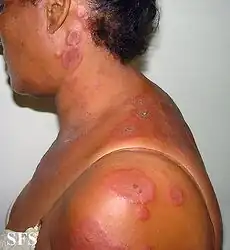 Erythema multiforme
