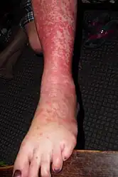 Erythema multiforme target lesions on the leg