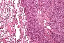 Micrograph of a metastatic Ewing sarcoma with the characteristic cytoplasmic clearing on H&E staining, which was showing to be PAS positive