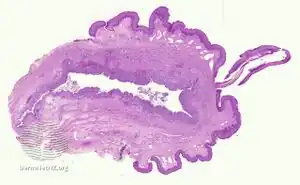 pathology-Median raphe cyst