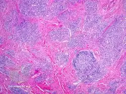 IgG4-related skin disease pathology