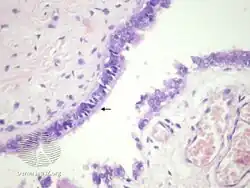 pathology-Cutaneous ciliated cyst