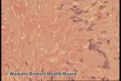 Necrobiotic xanthogranuloma-pathology