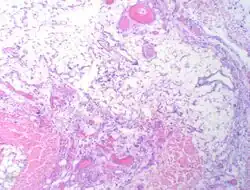 Myxofibrosarcoma-pathology