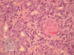 Aggressive digital papillary adenocarcinoma-pathology