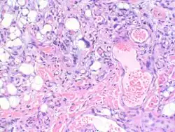 Myxofibrosarcoma-pathology