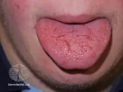 Fissured tongue