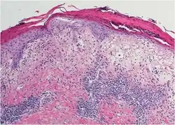 Melanin incontinence