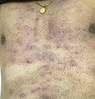 Folliculitis post shaving