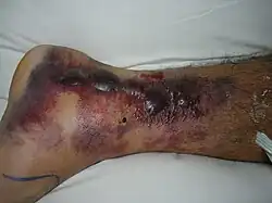 Hemorrhagic fracture blisters on medial aspect of left foot and ankle. X-ray shows a Weber type B fracture of the ankle