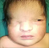 Image of infant with Fraser Syndrome