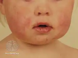 Gianotti–Crosti syndrome