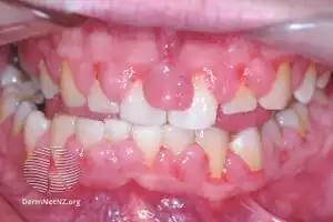 Gingival enlargement