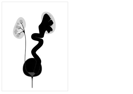 High grade vesico-ureteric reflux - easily mistaken for cystic renal disease on early scans