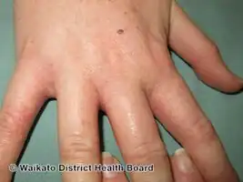 Contact dermatitis-isocyanate