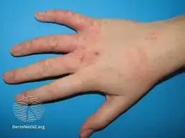Hand eczema
