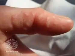 Hand foot and mouth disease