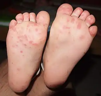 Hand foot and mouth disease on childs feet