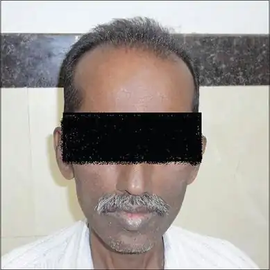 Iron overload in a 48 year old from India