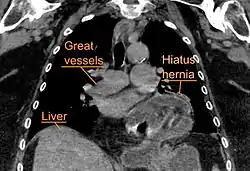 A hiatal hernia as seen on CT