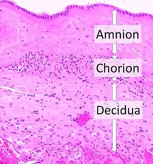 Acute choriodeciduitis, with neutrophils seen in the chorion and decidua.