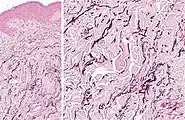 Histopathology: Accumulation of fragmented elastotic material within the papillary dermis and transcutaneous elimination of elastotic fibers.
