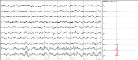 Human EEG with prominent alpha-rhythm