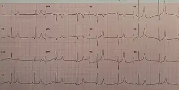 An ECG of a person with a potassium of 5.7 mg/dL showing large T waves and small P waves