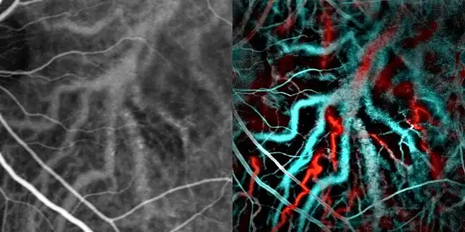 Indocyanine green angiography (left) and laser Doppler imaging (right) of the macula in central serous retinopathy, revealing choroidal vessels. Blue and red correspond ot low and high blood flow respecively.