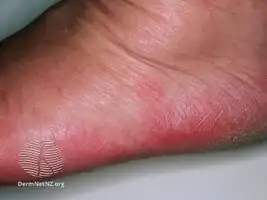 Idiopathic plantar hidradenitis
