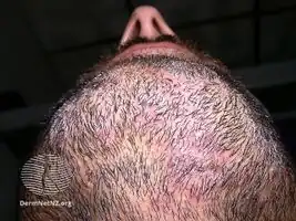 Tinea barbae (superficial)