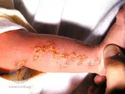 Incontinentia pigmenti