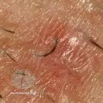 Ingrowing beard hair