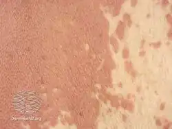 Interstitial granulomatous dermatitis