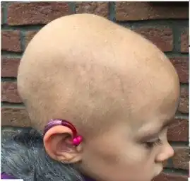 Individual with Bjornstad syndrome