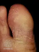 Juvenile plantar dermatosis