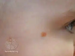 Juvenile xanthogranuloma