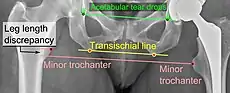 Leg length discrepancy after hip replacement is calculated as the vertical distance between the middle of the minor trochanters, using the acetabular tear drops or the transischial line as references for the horizontal plane. A discrepancy of up to 1 cm is generally tolerated.