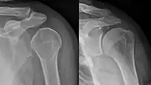 Lightbulb sign indicative of posterior shoulder dislocation shown on the left. On the right, the same shoulder after reduction.
