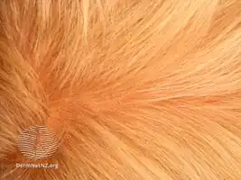 Loose anagen syndrome