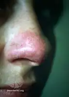 Lupus pernio (cutaneous sarcoidosis)