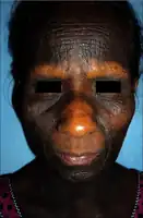 AN in ovarian cancer