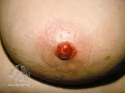 Mammary Paget disease of the skin