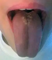 Median rhomboid glossitis in a child. Note atypical appearance of the lesion, which is more commonly an erythematous, atrophic area of depapillation