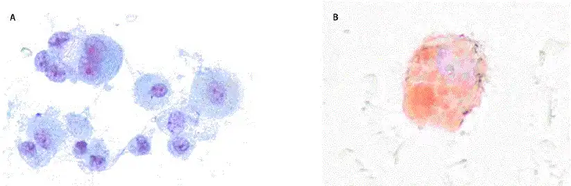 Bronchoalveolar lavage sample from a patient with acute lung injury associated with vaping, showing alveolar macrophages laden with vacuoles (A) and extensive lipid deposits (B)