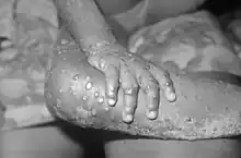 Mpox in Liberia (1971)
