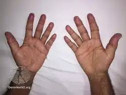 Multicentric reticulohistiocytosis