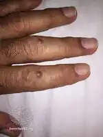 Multicentric reticulohistiocytosis